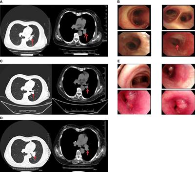Rare case report: a case of histological type transformation of lung cancer caused by neoadjuvant immunotherapy